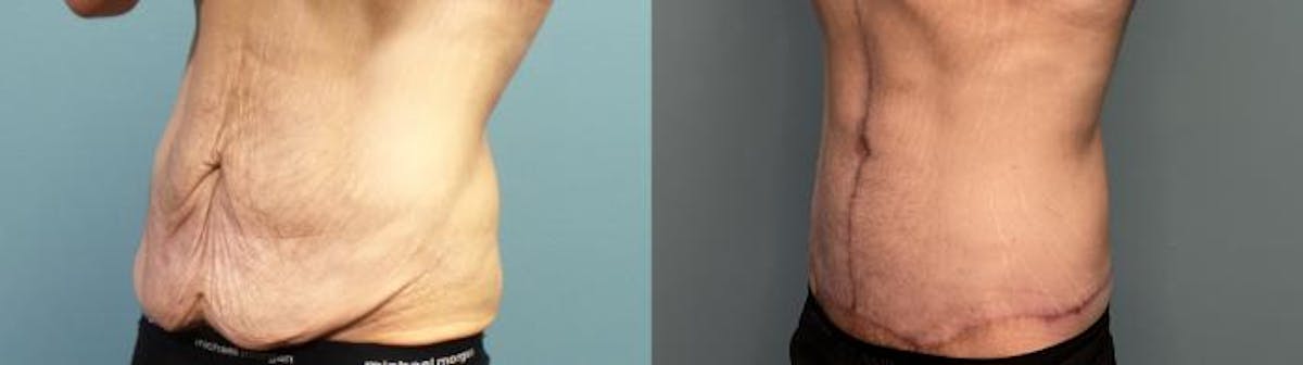 Massive Weight Loss/Body Lift Before & After Gallery - Patient 101994 - Image 2