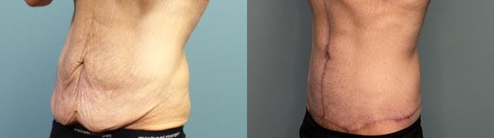 Massive Weight Loss/Body Lift Before & After Gallery - Patient 101994 - Image 2