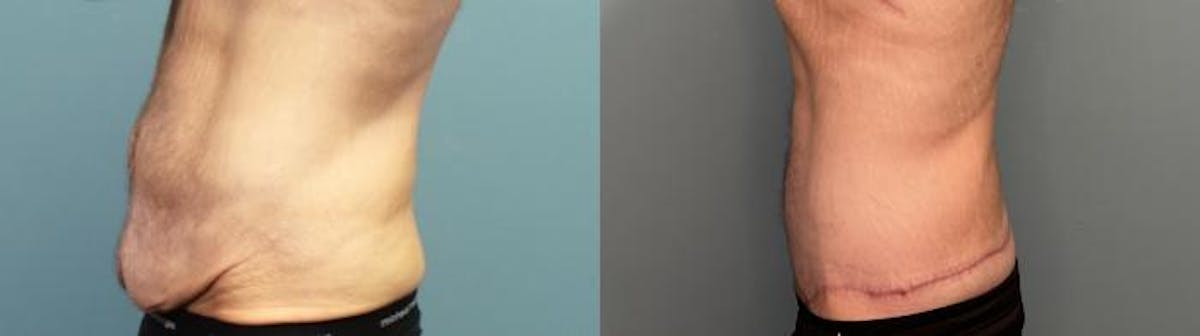 Massive Weight Loss/Body Lift Before & After Gallery - Patient 101994 - Image 3