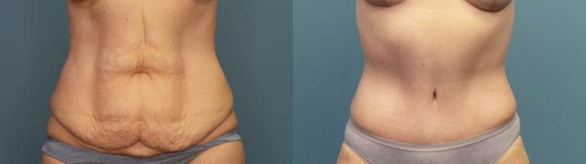 Massive Weight Loss/Body Lift Before & After Gallery - Patient 198667 - Image 1