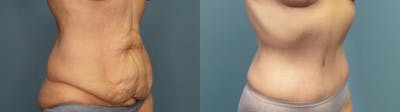 Massive Weight Loss/Body Lift Before & After Gallery - Patient 198667 - Image 2