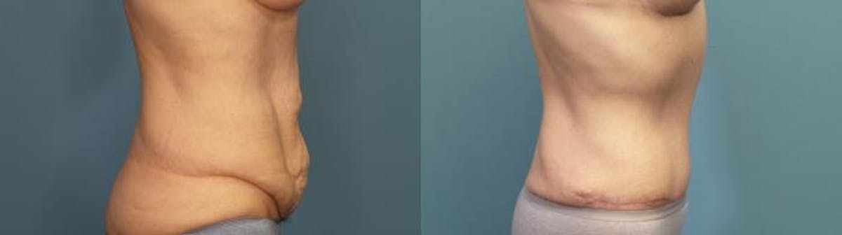 Massive Weight Loss/Body Lift Before & After Gallery - Patient 198667 - Image 3