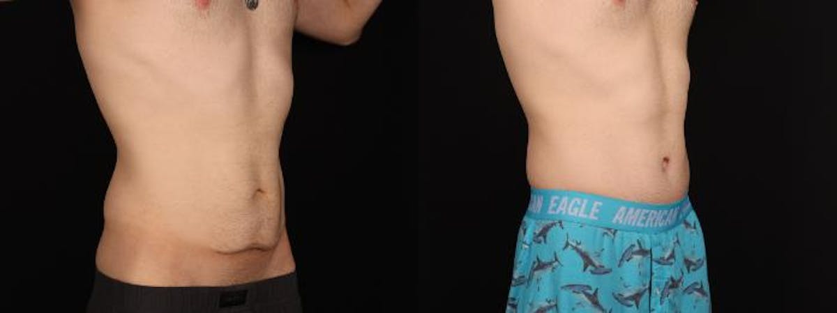 Massive Weight Loss/Body Lift Before & After Gallery - Patient 361797 - Image 1