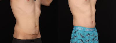 Massive Weight Loss/Body Lift Before & After Gallery - Patient 361797 - Image 1