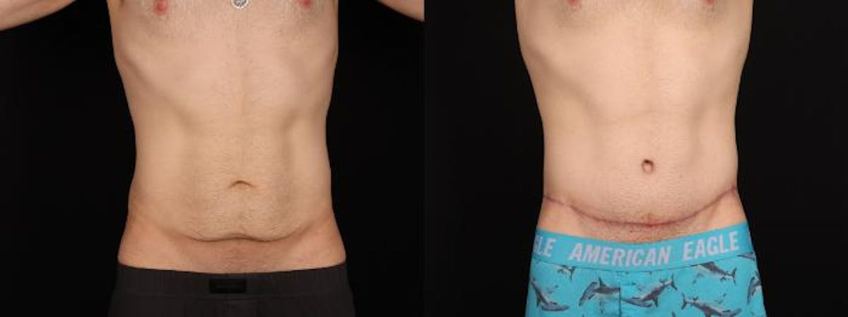 Massive Weight Loss/Body Lift Before & After Gallery - Patient 361797 - Image 2
