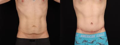 Massive Weight Loss/Body Lift Before & After Gallery - Patient 361797 - Image 2