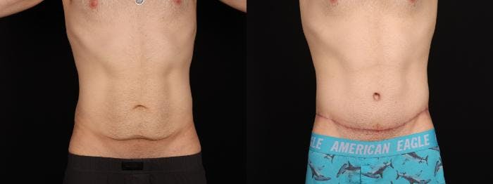 Massive Weight Loss/Body Lift Before & After Gallery - Patient 361797 - Image 2