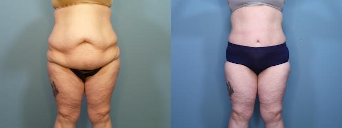 Massive Weight Loss/Body Lift Before & After Gallery - Patient 114309 - Image 1