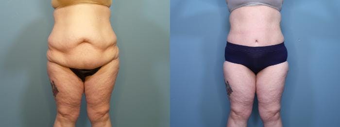 Massive Weight Loss/Body Lift Before & After Gallery - Patient 114309 - Image 1