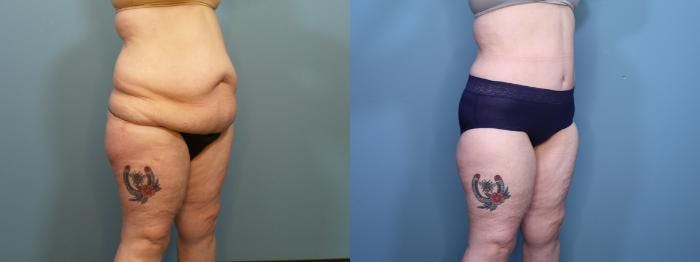 Massive Weight Loss/Body Lift Before & After Gallery - Patient 114309 - Image 2