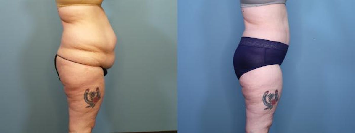 Massive Weight Loss/Body Lift Before & After Gallery - Patient 114309 - Image 3