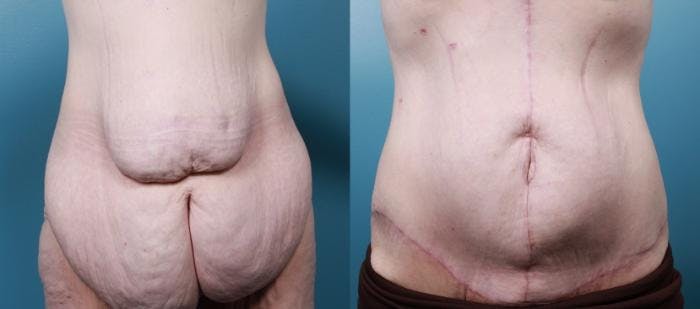 Massive Weight Loss/Body Lift Before & After Gallery - Patient 415523 - Image 1