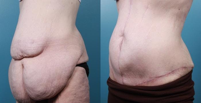 Massive Weight Loss/Body Lift Before & After Gallery - Patient 415523 - Image 2