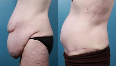 Massive Weight Loss/Body Lift Before & After Gallery - Patient 415523 - Image 3