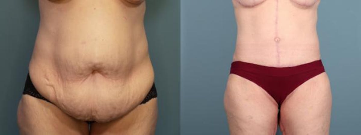 Massive Weight Loss/Body Lift Before & After Gallery - Patient 298546 - Image 1