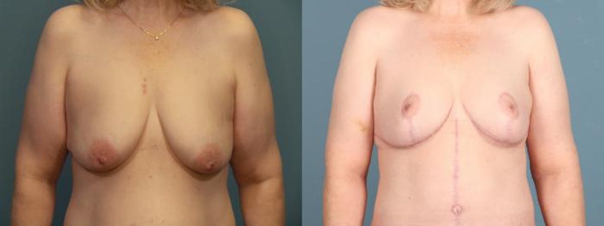 Massive Weight Loss/Body Lift Before & After Gallery - Patient 298546 - Image 3