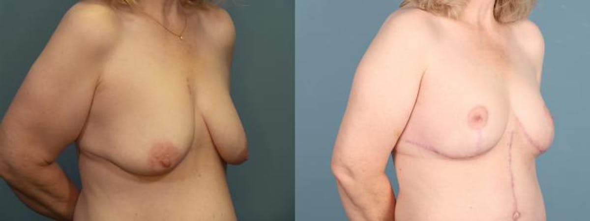 Massive Weight Loss/Body Lift Before & After Gallery - Patient 298546 - Image 4