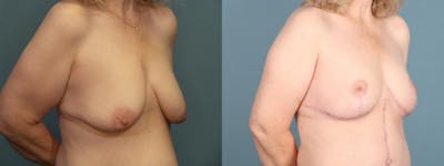 Massive Weight Loss/Body Lift Before & After Gallery - Patient 298546 - Image 4