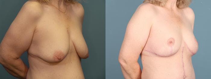 Massive Weight Loss/Body Lift Before & After Gallery - Patient 298546 - Image 4