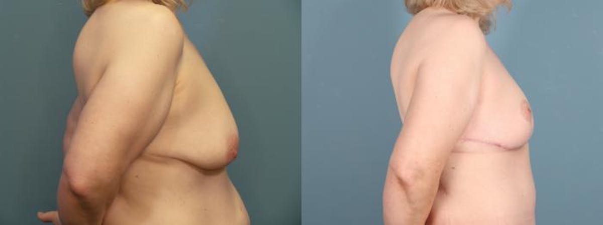 Massive Weight Loss/Body Lift Before & After Gallery - Patient 298546 - Image 5