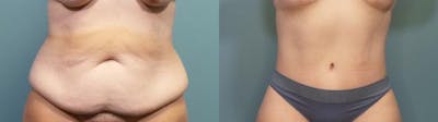 Massive Weight Loss/Body Lift Before & After Gallery - Patient 363888 - Image 1