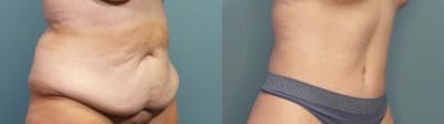 Massive Weight Loss/Body Lift Before & After Gallery - Patient 363888 - Image 2