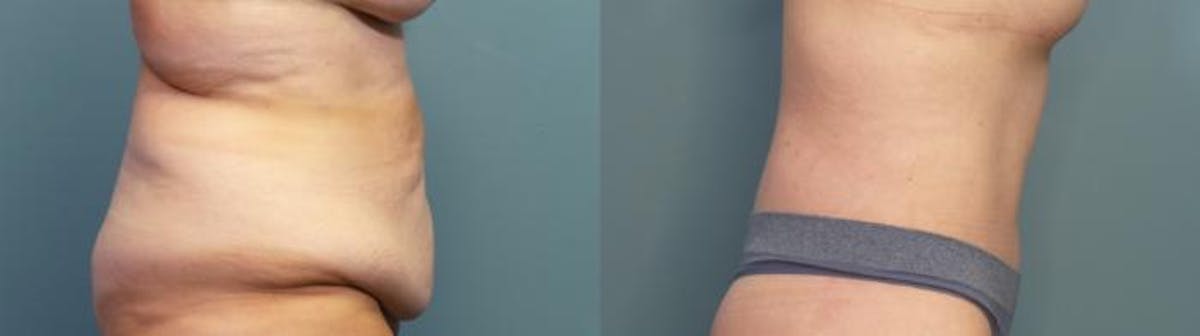 Massive Weight Loss/Body Lift Before & After Gallery - Patient 363888 - Image 3