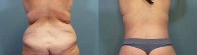 Massive Weight Loss/Body Lift Before & After Gallery - Patient 363888 - Image 4