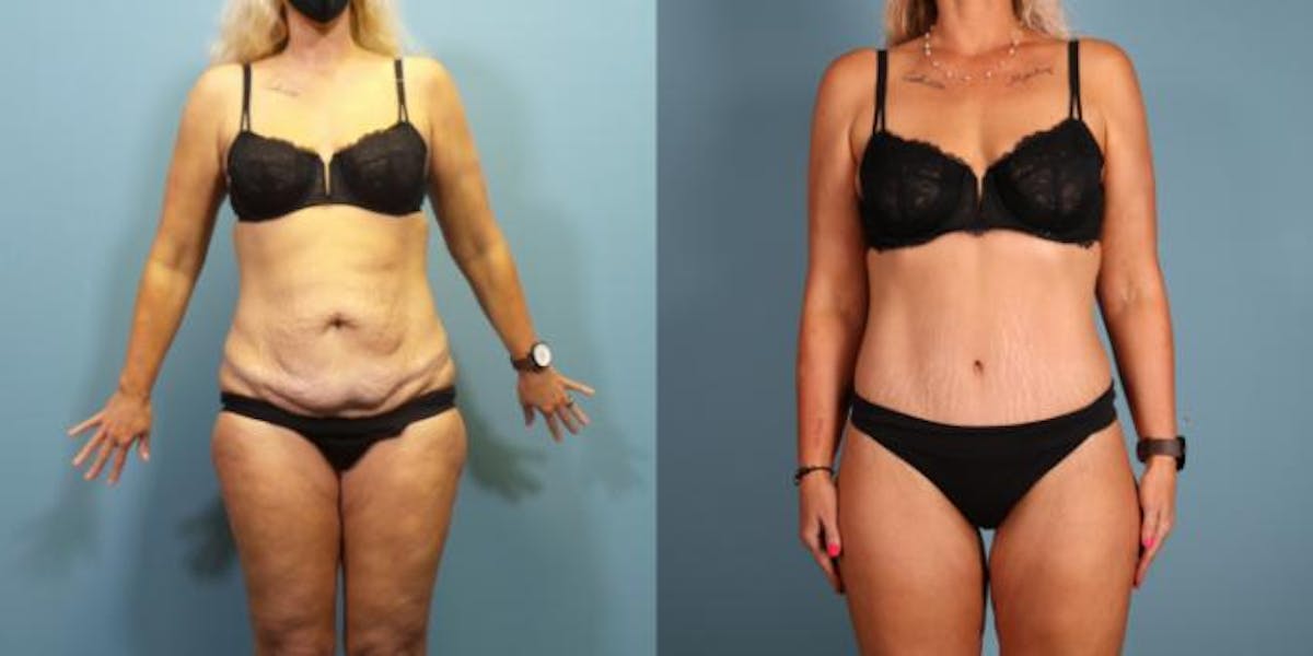 Massive Weight Loss/Body Lift Before & After Gallery - Patient 731660 - Image 1