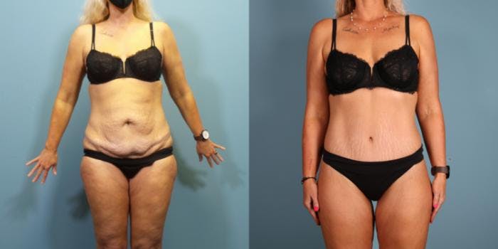 Massive Weight Loss/Body Lift Before & After Gallery - Patient 731660 - Image 1