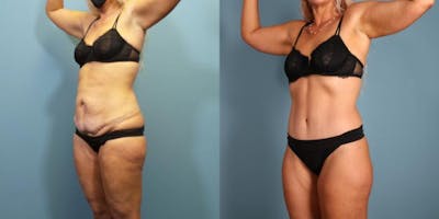 Massive Weight Loss/Body Lift Before & After Gallery - Patient 731660 - Image 2