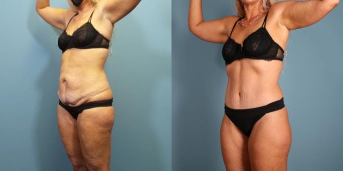 Massive Weight Loss/Body Lift Before & After Gallery - Patient 731660 - Image 2