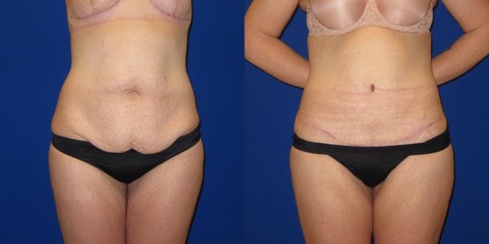 Massive Weight Loss/Body Lift Before & After Gallery - Patient 401374 - Image 1
