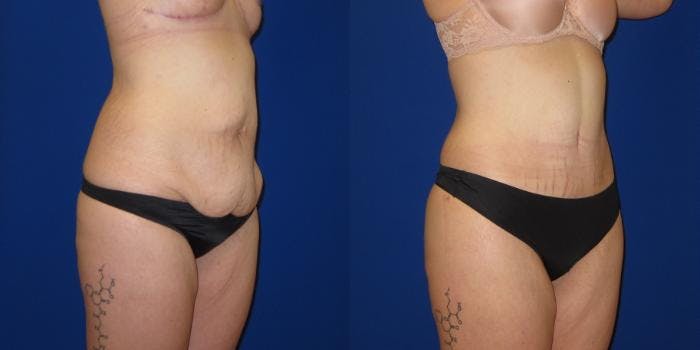 Massive Weight Loss/Body Lift Before & After Gallery - Patient 401374 - Image 2