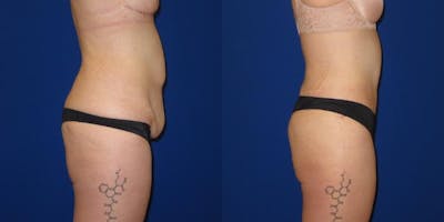 Massive Weight Loss/Body Lift Before & After Gallery - Patient 401374 - Image 3