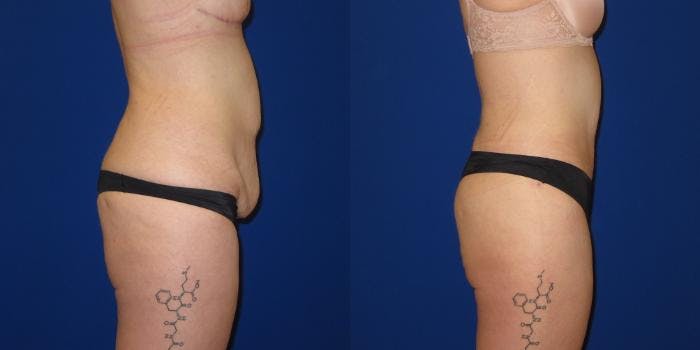 Massive Weight Loss/Body Lift Before & After Gallery - Patient 401374 - Image 3