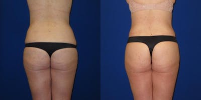 Massive Weight Loss/Body Lift Before & After Gallery - Patient 401374 - Image 4