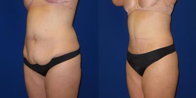Massive Weight Loss/Body Lift Before & After Gallery - Patient 401374 - Image 5
