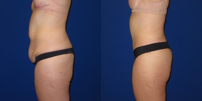 Massive Weight Loss/Body Lift Before & After Gallery - Patient 401374 - Image 6