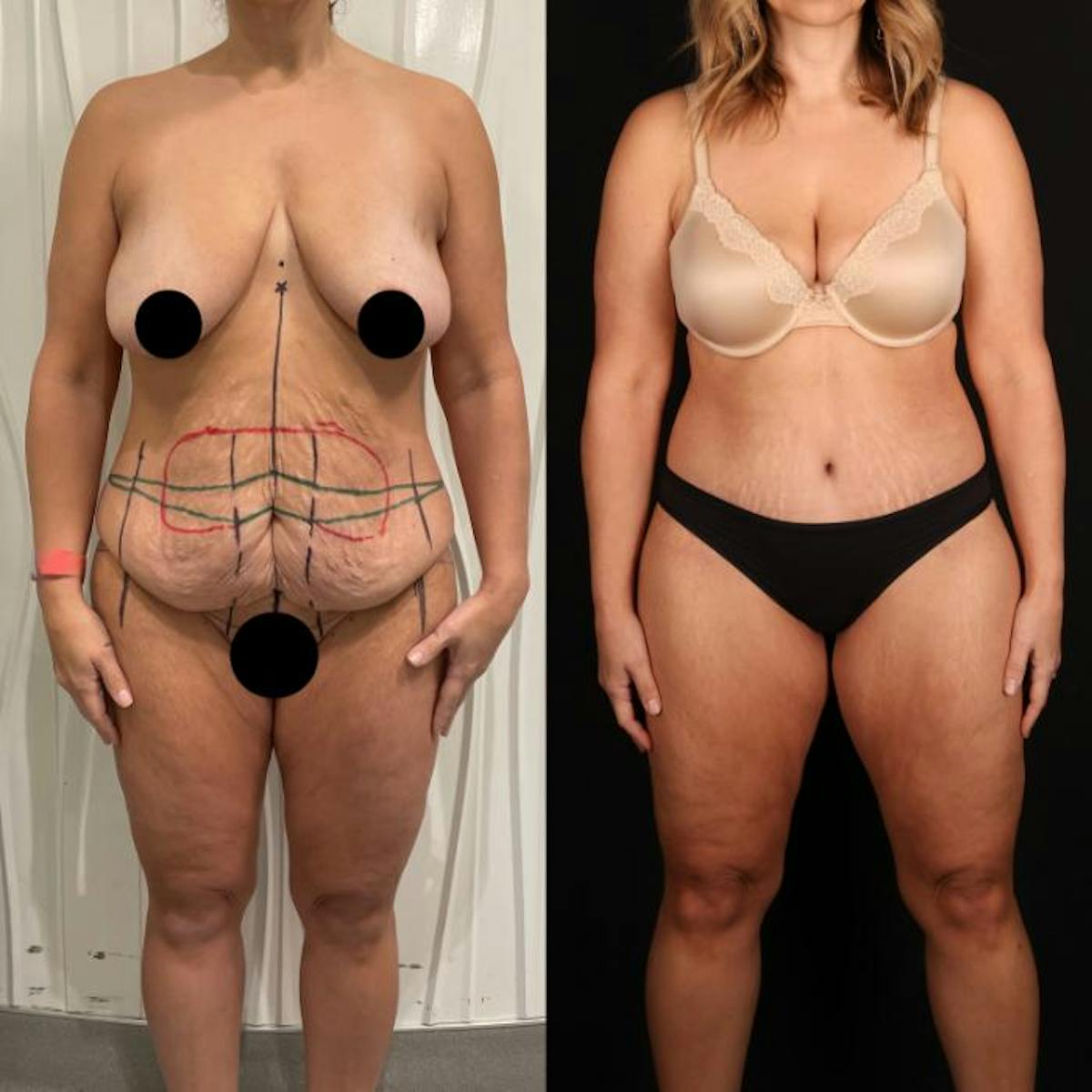 Massive Weight Loss/Body Lift Before & After Gallery - Patient 208944 - Image 1