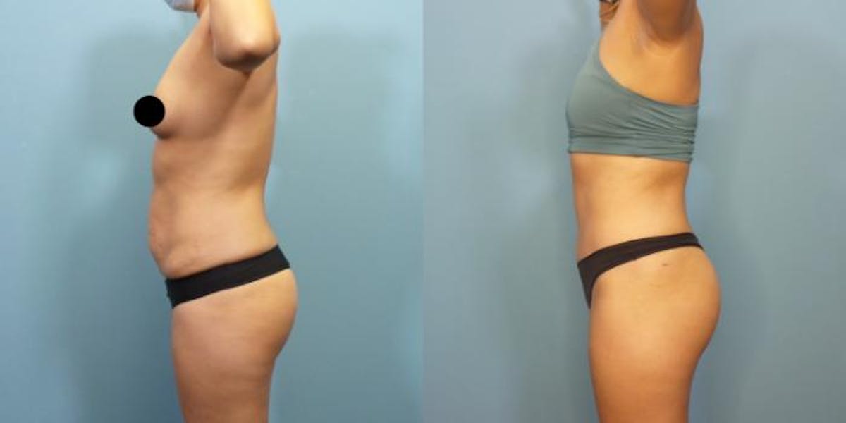 Liposuction Before & After Gallery - Patient 337555 - Image 1