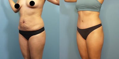 Liposuction Before & After Gallery - Patient 337555 - Image 2