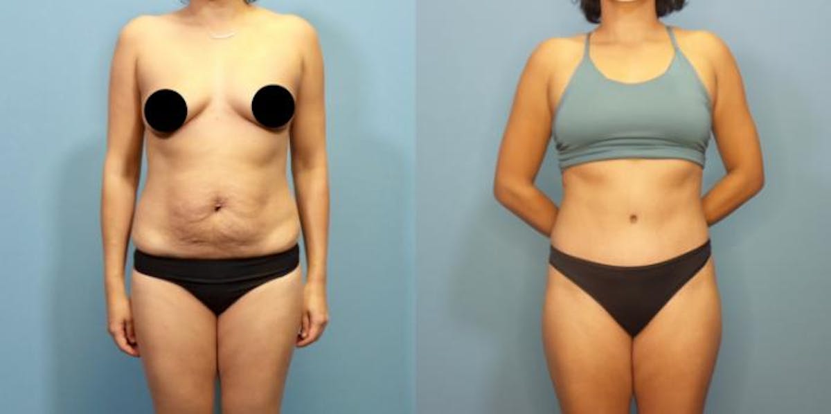 Liposuction Before & After Gallery - Patient 337555 - Image 3