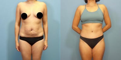 Liposuction Before & After Gallery - Patient 337555 - Image 3