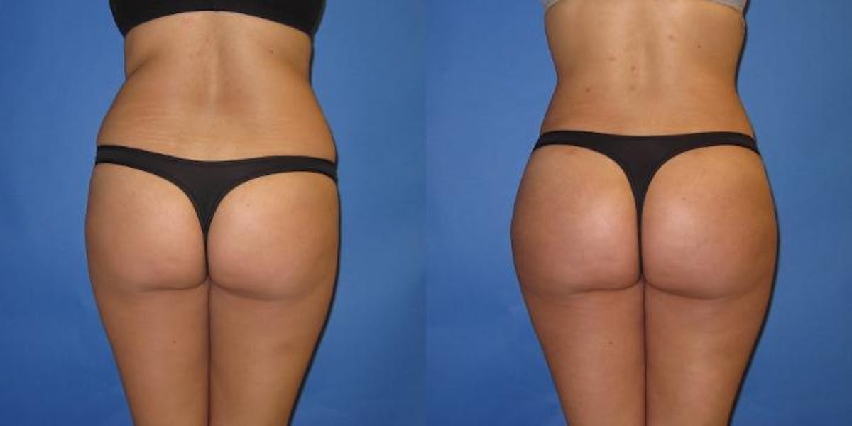Liposuction Before & After Gallery - Patient 204849 - Image 1