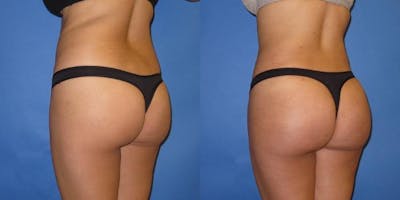 Liposuction Before & After Gallery - Patient 204849 - Image 2