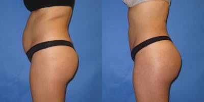 Liposuction Before & After Gallery - Patient 204849 - Image 3