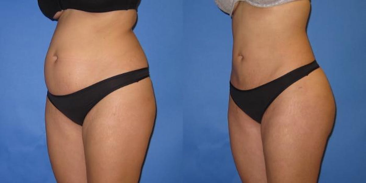 Liposuction Before & After Gallery - Patient 204849 - Image 4