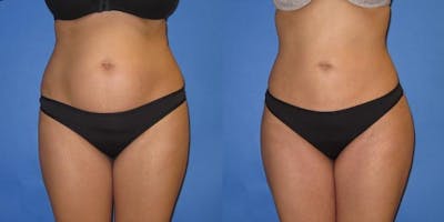 Liposuction Before & After Gallery - Patient 204849 - Image 5