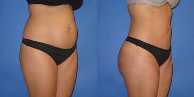 Liposuction Before & After Gallery - Patient 204849 - Image 6